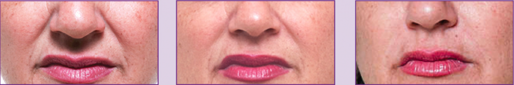 Before-After 1&2 treatments