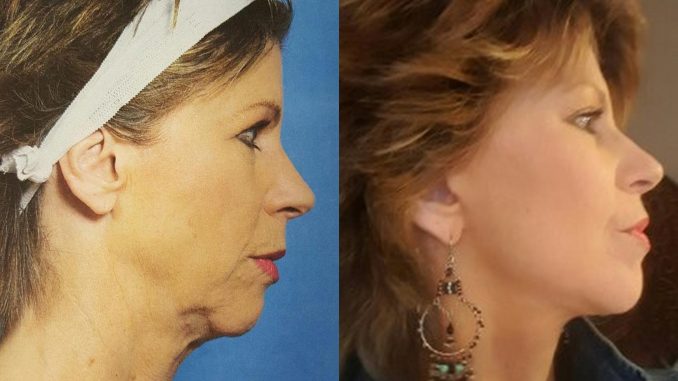Sherrie Brown B&A Right Side