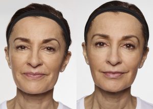 Restylane silk Before and After photo - available from Dr. Brian Machida, facial plastic surgeon, Inland Empire California