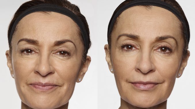 Carol - before and after Restylane Restylane Inland Empire, Restylane San Diego, Restylane Cleveland