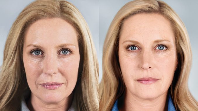 Elissa B&A Sculptra -closeup Sculptra Before and After photo available from Dr. Brian Machida, facial plastic surgeon Inland Empire CA