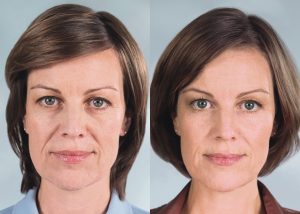 Sculptra Before and After photo - available from Dr. Brian Machida, facial plastic surgeon, Ontario, California