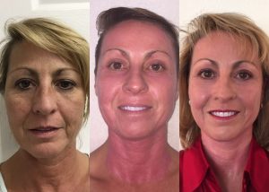 J-Plasma offered by Dr. Arnold Almonte, plastic surgeon, Sacramento, CA, Dr. Brian Machida, facial plastic surgeon, Inland Empire, Los Angeles, CA, California
