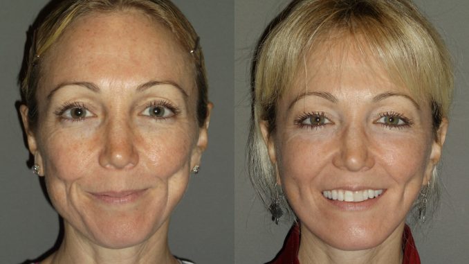 Facelift, neck lift by Dr. Brian Machida, facial plastic surgeon, Inland Empire, California