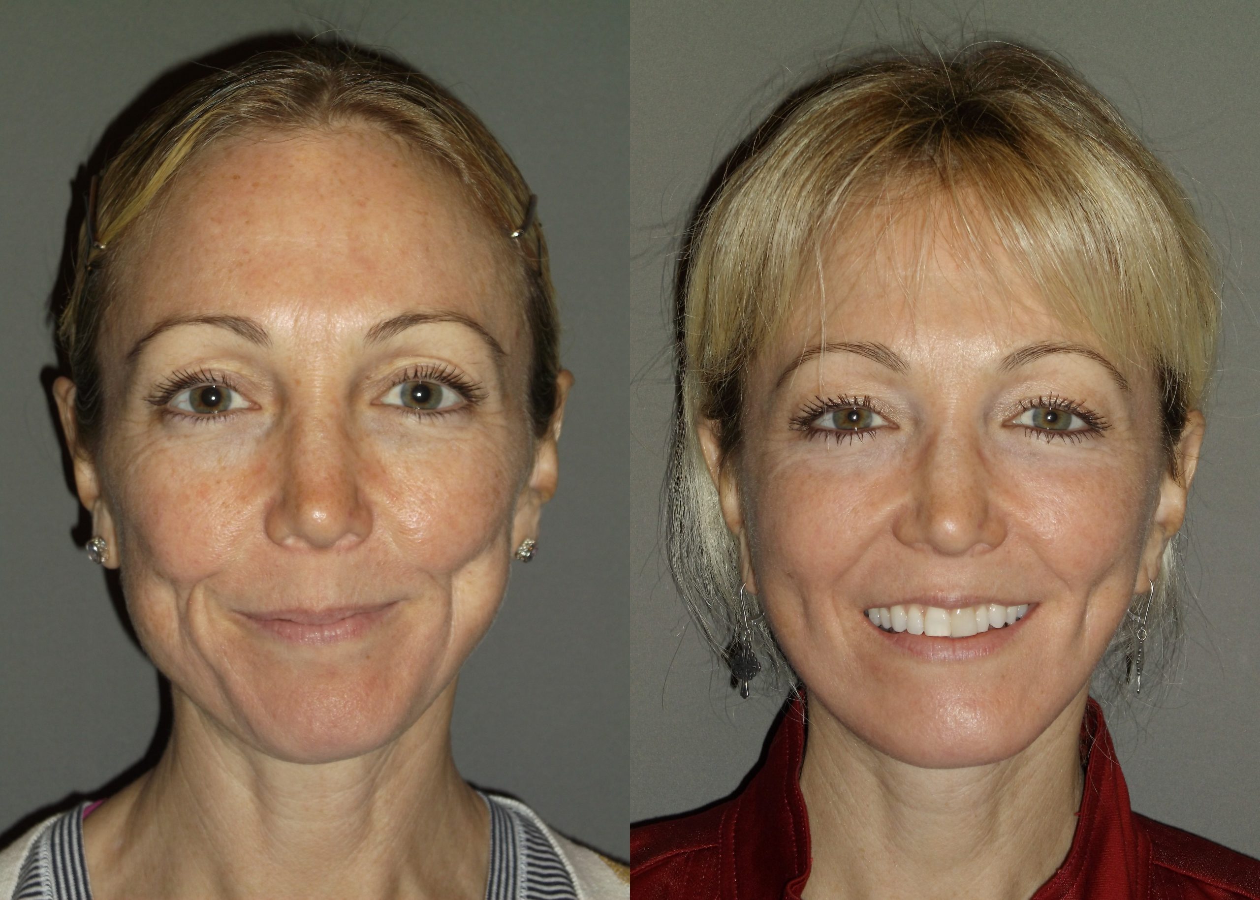 facelift-disasters-why-they-happen-and-how-to-avoid-one-larry-rondeau