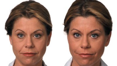 fillers-by-dr-ritu-malhotra-cleveland-oh Filler Before & After Dr. Ritu Malhotra Cleveland, OH