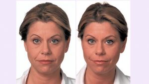 Juvederm, Voluma, Restylane cheek filler Cleveland by Dr. Ritu Malhotra, facial plastic surgeon, Cleveland, OH