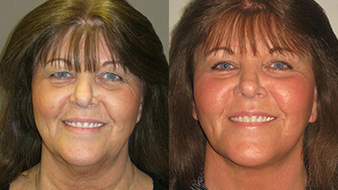 Facelift, necklift by Dr. Brian Machida, facial plastic surgeon-Theresa double chin, turkey neck, Facelift, neck lift by Dr. Brian Machida, facial plastic surgeon, Inland Empire, California