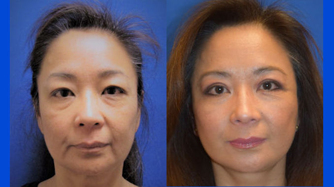 Blepharoplasty, facelift by Dr. Arnold Almonte of metro Sacramento California Blepharoplasty, facelift by Dr. Arnold Almonte, plastic surgeon, Sacramento, California Before & After