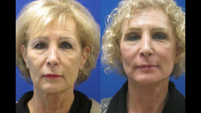 laser facelift Facial resurfacing