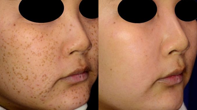 PicoSure BA age spot removal offered by Dr. Brian Machida, facial plastic surgeon, Inland Empire, California PicoSure Before & After Latina complexion, brown spot, age spot removal offered by Dr. Brian Machida, facial plastic surgeon, Inland Empire, California