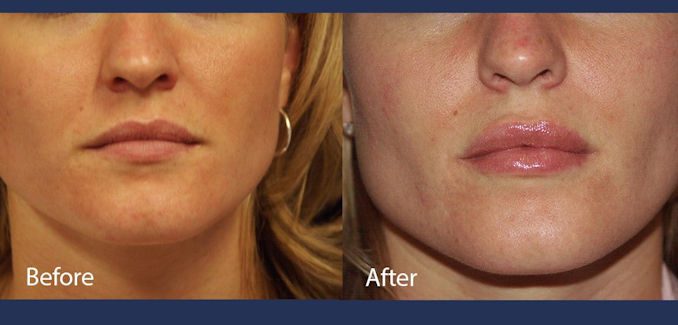 Lip Enhancement - Before & After-by Dr. Mitchell Blum, facial plastic surgeon, metro San Francisco, CA Lip enhancement, for full lips before and after lip injections by Dr. Mitchell Blum, facial plastic surgeon, San Francisco East Bay California