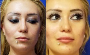 lip injections, Before and After Refyne injection by Dr. Mitchell Blum, facial plastic surgeon, San Francisco East Bay California
