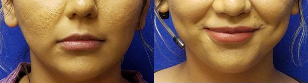 lip injectections, Before and After Defyne lip filler by Dr. Mitchell Blum, facial plastic surgeon, San Francisco East Bay CA