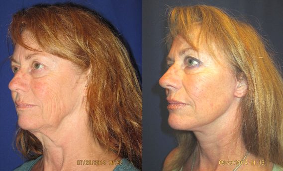 chin implant, facelift by Dr. Mitchell Blum, facial plastic surgeon, San Francisco, Bay Area, CA, Before and After