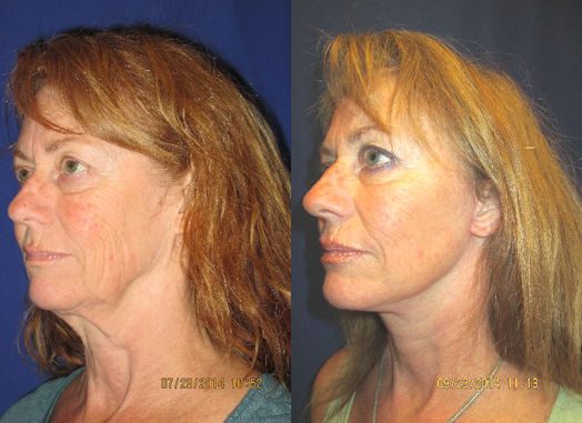 Spotlight Befe & After facelift, neck liftby Dr. Mitchell Blum, facial plastic surgeon, Bay Area, CA Bay Area facelift, neck lift, Dr. Mitchell Blum, facial plastic surgeon Before and After