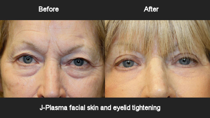 J-Plasma Blepharoplasty Before & After-cap J-Plasma skin and eyelid tightening offered by Dr. Brian Machida, facial plastic surgeon, Inland Empire, Los Angeles,CA, Dr. Arnold Almonte, plastic surgeon, Sacramento, California