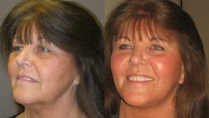 facelift,, neck lift, blepharoplasty, laser skin resurfacing by Dr. Brian Machida, facial plastic surgeon, Inland Empire, California, CA