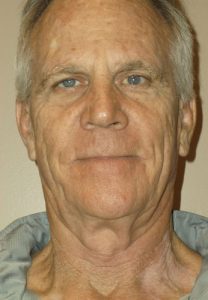 Before face lift, lower facelift by Dr. Brian Machida, facial plastic surgeon, Inland Empire, Los Angeles, California, CA