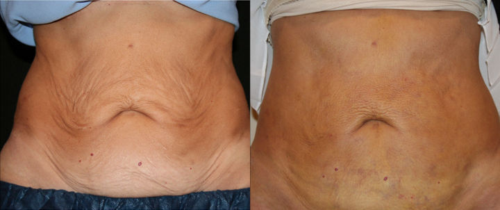 J Plasma Before And After Stomach