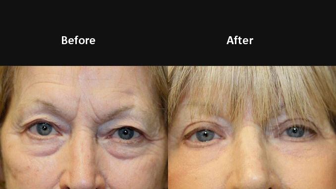 Renuvion Blepharoplasty FF noninvasive blepharoplasty, Renuvion, J-Plasma, blepharoplasty