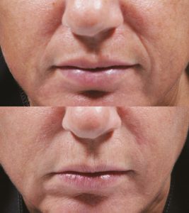 Bellafill wrinkles Inland Empire, nasolabial folds, marionette lines, filler, cheek filler