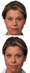 Juvederm,Voluma, Restylane, cheek filler, Dr. Ritu Malhtora, Cleveland, OH