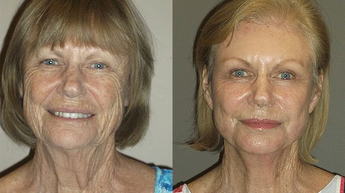 Renuvion J-Plasma wrinkles Inland Empire by Dr. Brian Machida Renuvion J-Plasma wrinkles Inland Empire by Dr. Brian Machida facial plastic surgeon