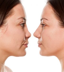 Non surgical nose job, Inland Empire, liquid rhinoplasty, Dr. Brian Machida, facial plastic surgeon