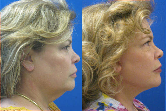 double chin Cleveland, facelift Cleveland, face lift Cleveland, neck lift Cleveland, blepharoplasty Cleveland, Dr. Ritu Malhotra, Enhanced Image Center