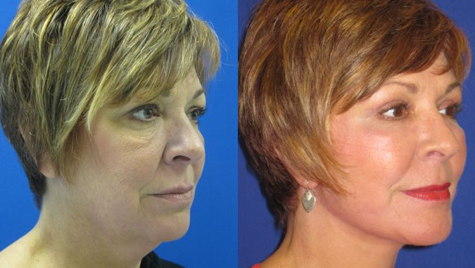 Theresa, 58 Before and After facelift Cleveland by Dr. Ritu Malhotra facelift Cleveland, face lift Cleveland by Dr. Ritu Malhotra, Before and After photo