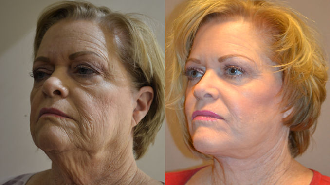 Facelift + Laser Inland Empire by Dr. Brian K. Machida facelift Inland Empire, laser Inland Empire