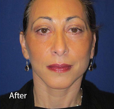 After Facelift By Dr. Mitchell Blum, Facial Plastic Surgeon, San ...