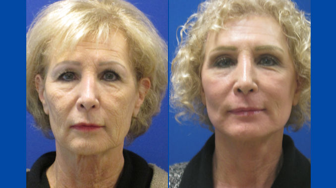 Janis 63 Before And After Laser Assisted Facelift Neck Lift Full Face Laser Resurfacing By Dr 