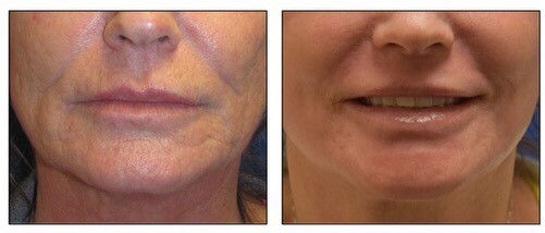 J-Plasma Chin Wrinkles Before & After treatment by Dr. Arnold Almonte ...