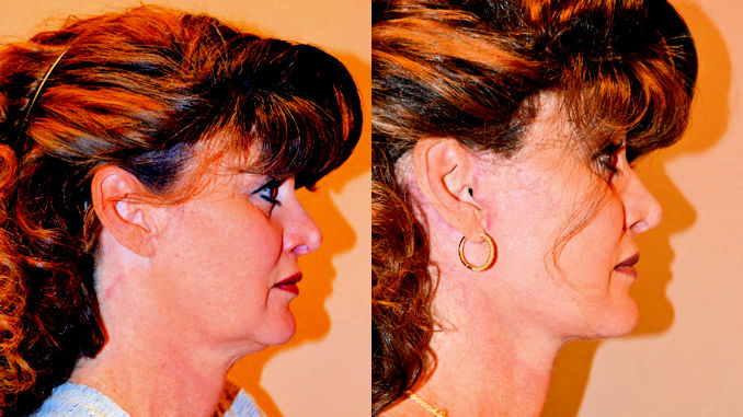 facelift-before-and-after-how-long-do-facelifts-last-lookyounger-news