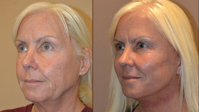 facelift-before-and-after-inland-empire-how-long-does-facelift-last-3