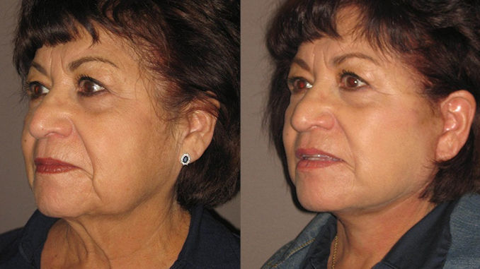 patient-73-before-and-after-lookyounger-news