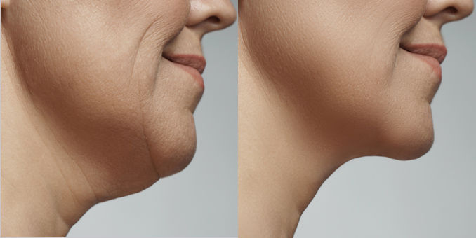 submandibular-gland-surgery-before-and-after-lookyounger-news