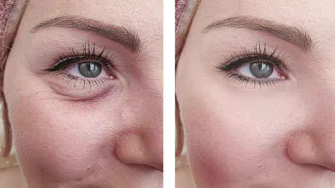 bags-under-your-eyes-what-s-the-better-solution-blepharoplasty-or